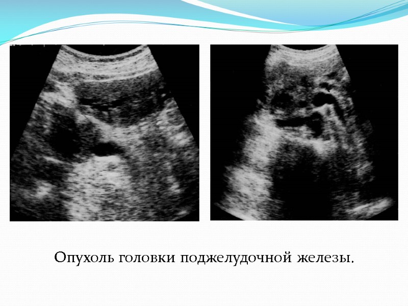 Опухоль головки поджелудочной железы.